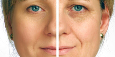 Sculptra course in London