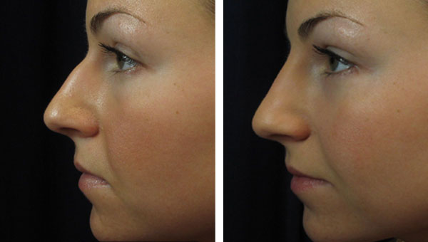 Nose reshaping rhinoplasty training course