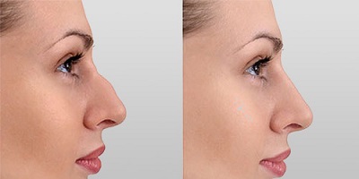 nose reshaping course in london