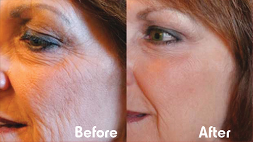 Skin Rejuvenation