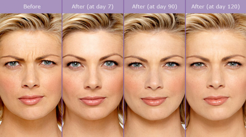 Dermal Fillers